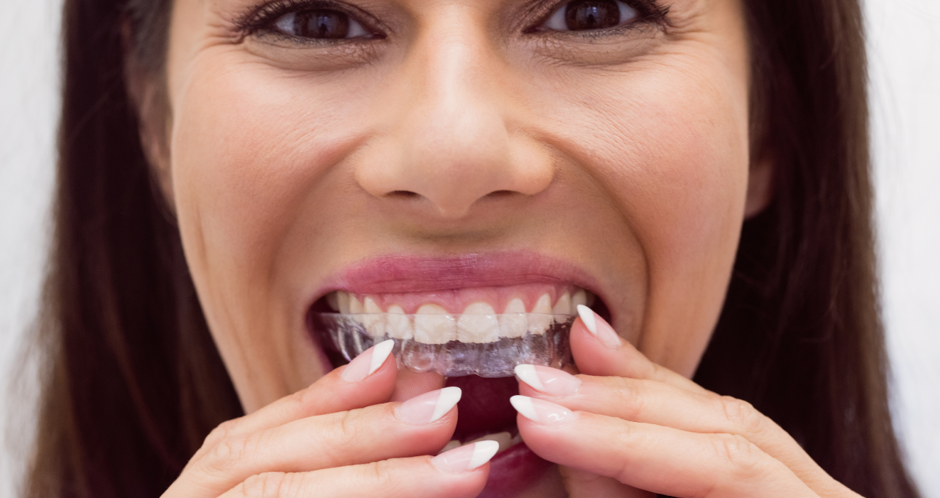 Achieve Your Dream Smile with Smile Perfect Aligners: Transform Your Teeth from Home