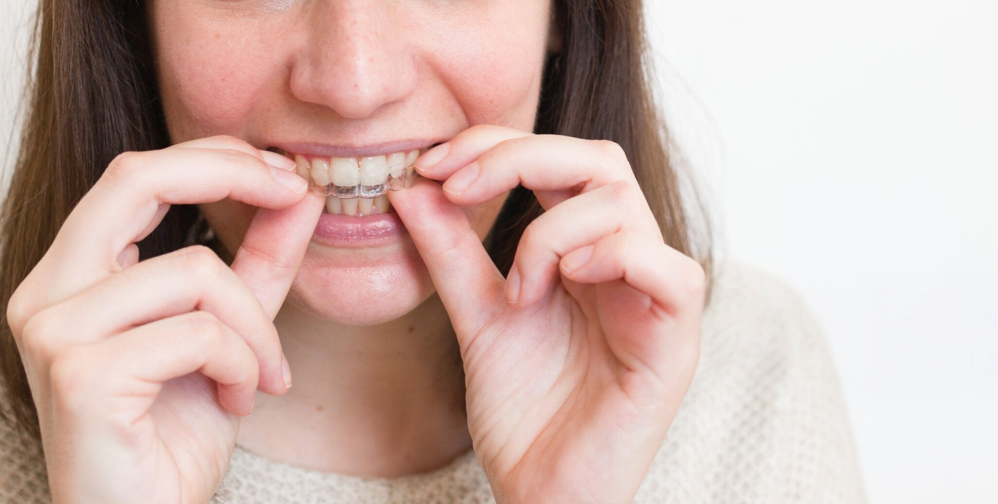 5 Reasons People Choose Clear Aligners Over Traditional Braces