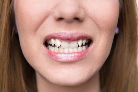 Crooked Teeth: Aesthetic Concern or Health Risk?