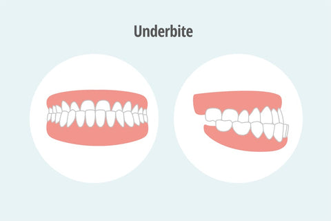 Understanding Underbite and How to Correct it with At-Home Clear Aligners