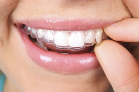 How Clear Aligners Work: Step-by-Step through the SmilePerfect Process