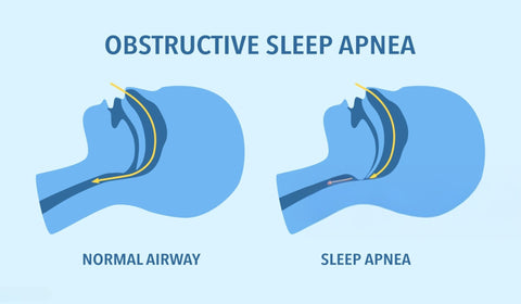 Teeth Straightening and Sleep Apnea: The Surprising Connection Your Dentist Might Not Mention