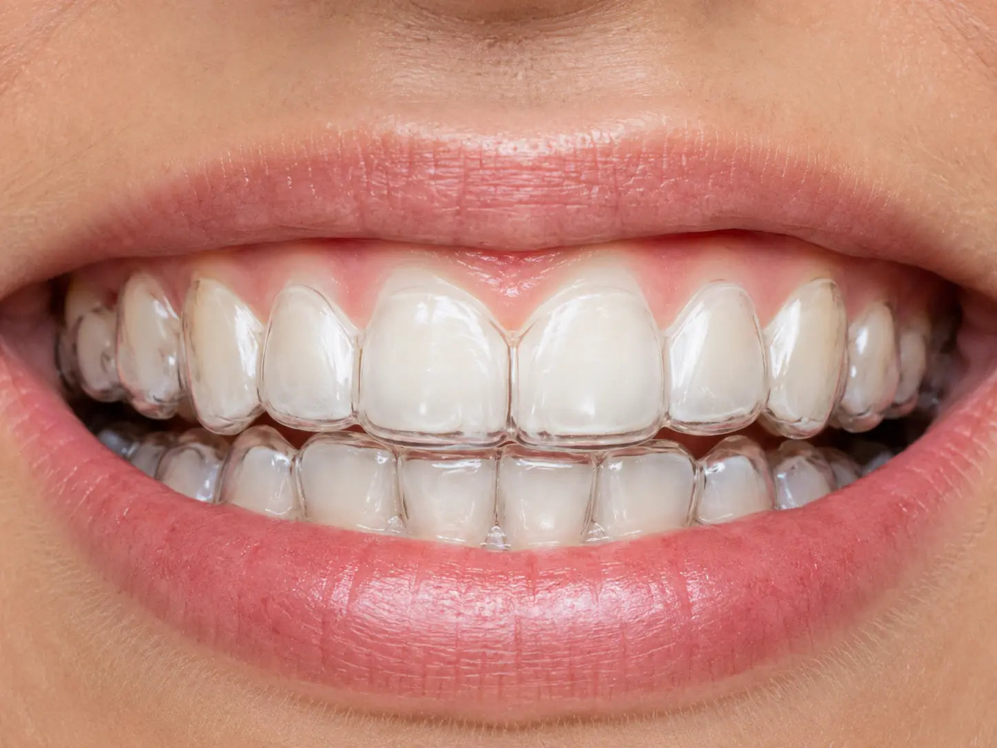 What to Do If Your Clear Aligners Don't Fit Properly