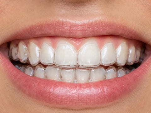 What to Do If Your Clear Aligners Don't Fit Properly