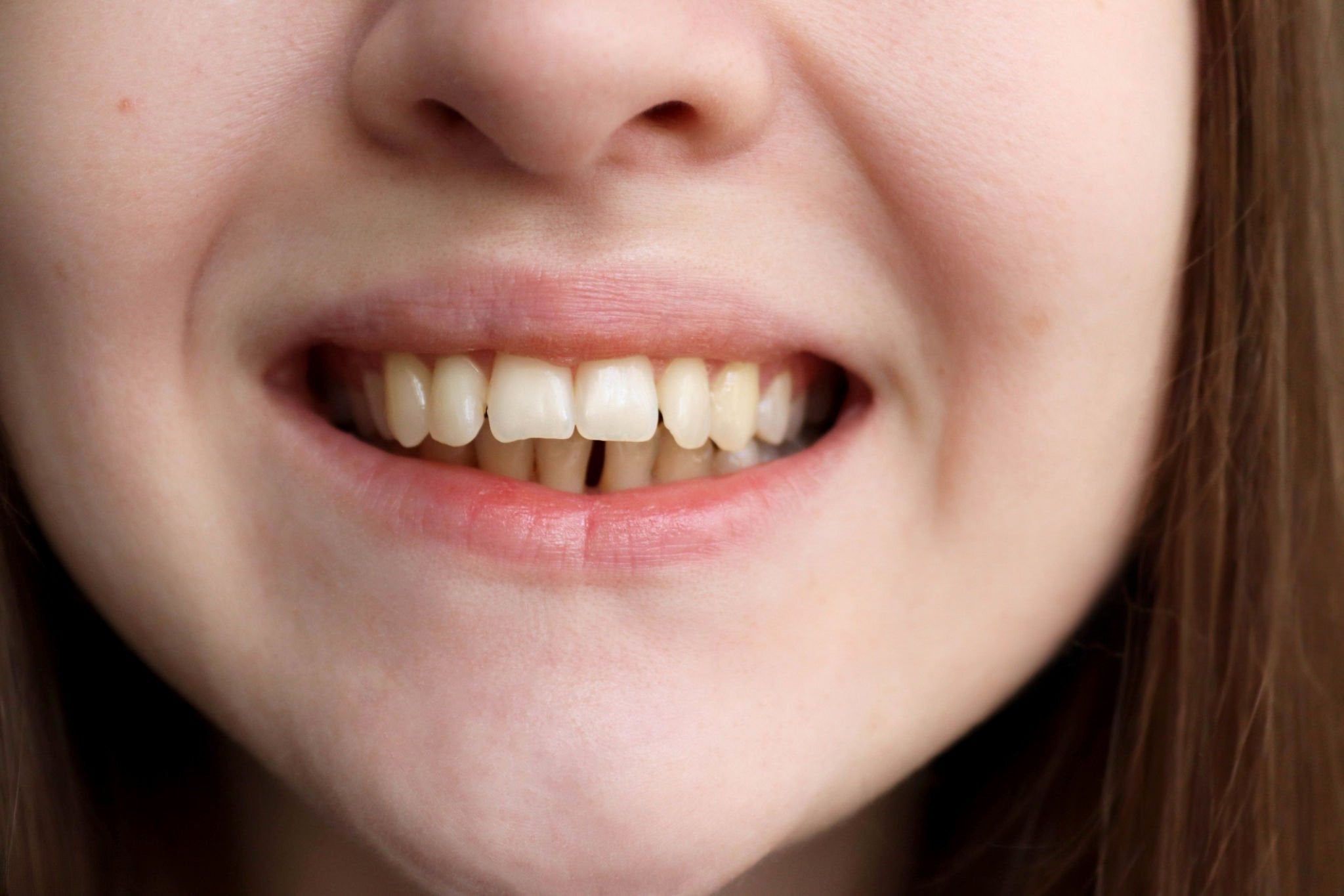 Overbite Explained: How Clear Aligners Can Help You Achieve a Perfect ...